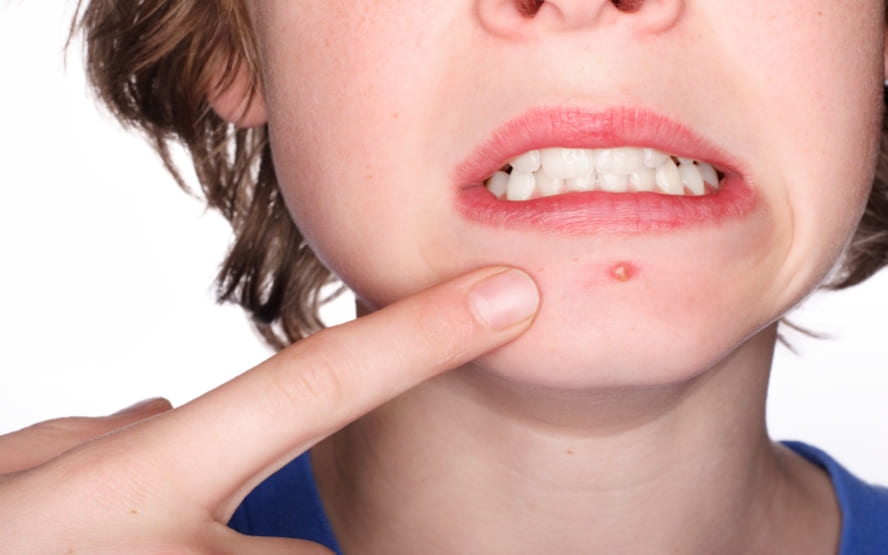 Como tratar a acne em adolescentes