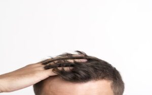 Tratamentos para perda de cabelo dos homens