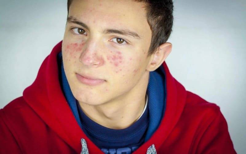 acne adolescente