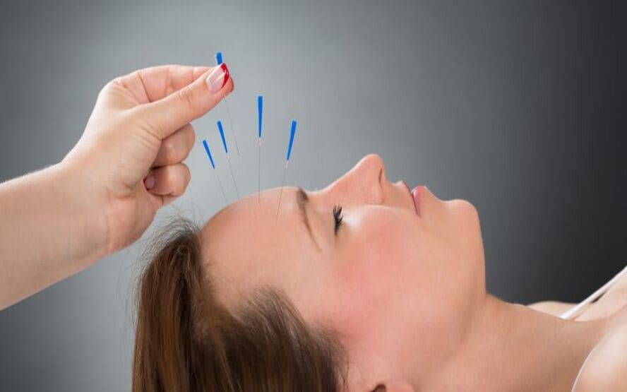 A acupuntura facial faz você realmente mais jovem