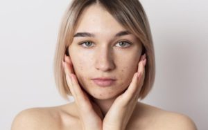Como funciona uma dieta hormonal para acne