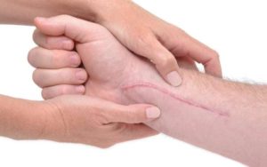 O que saber sobre tecido cicatricial 