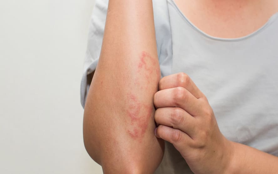 Quais sao os diferentes tipos de eczema