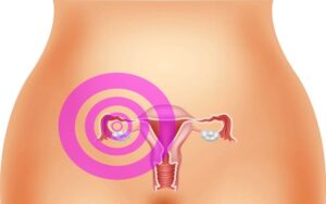 A endometriose e hereditaria