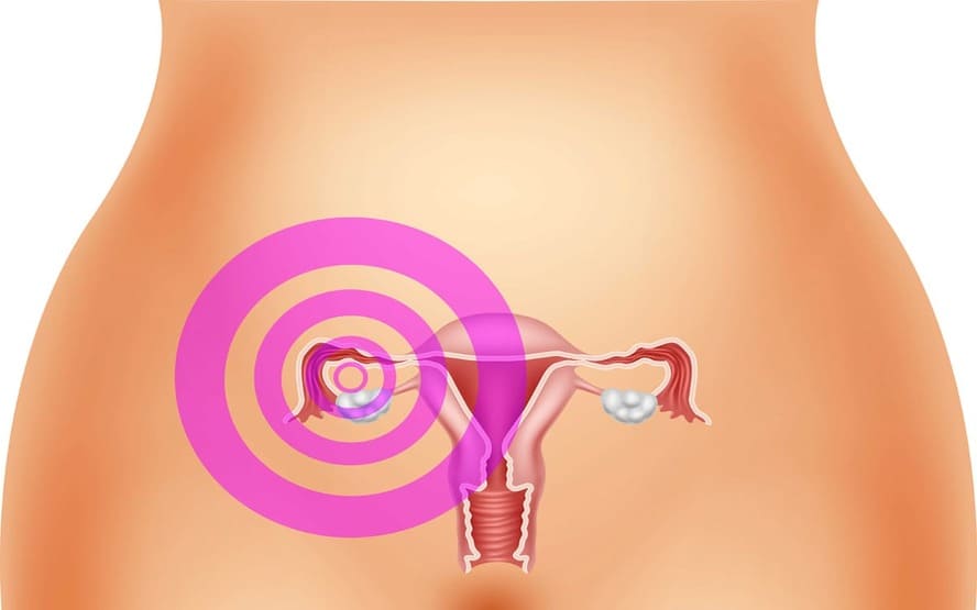 A endometriose é hereditária