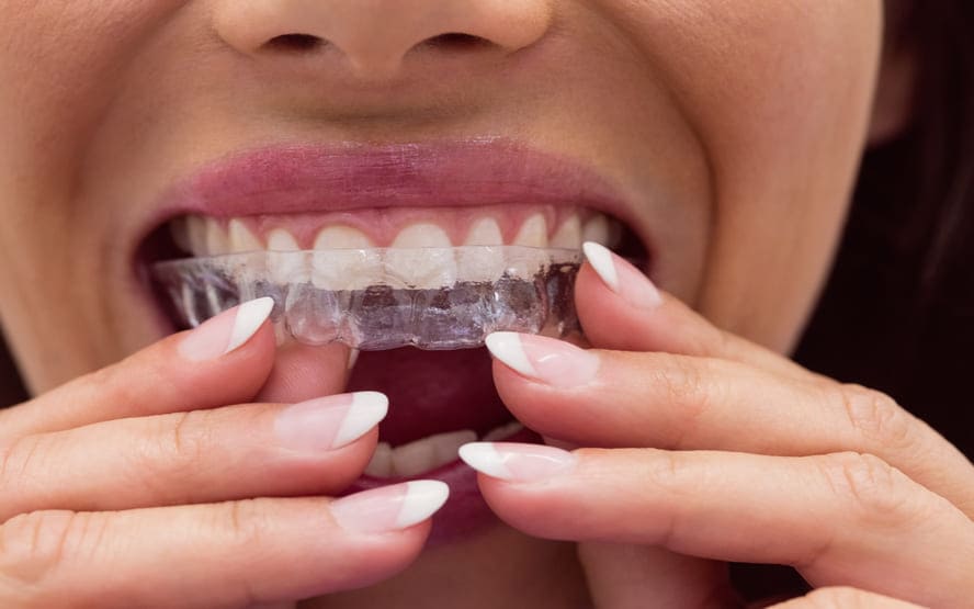 O que e o Invisalign e o que ele pode fazer por mim