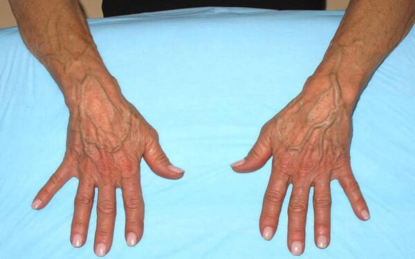 O que saber sobre as veias das mãos