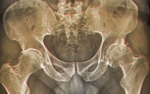 Como tratar a osteoartrite do quadril