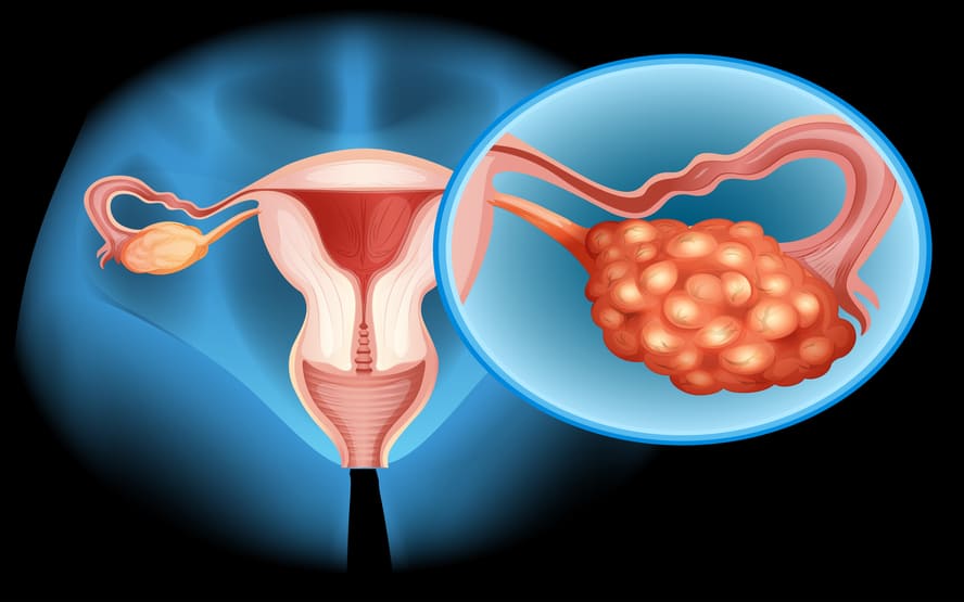 O que e cancer de ovario