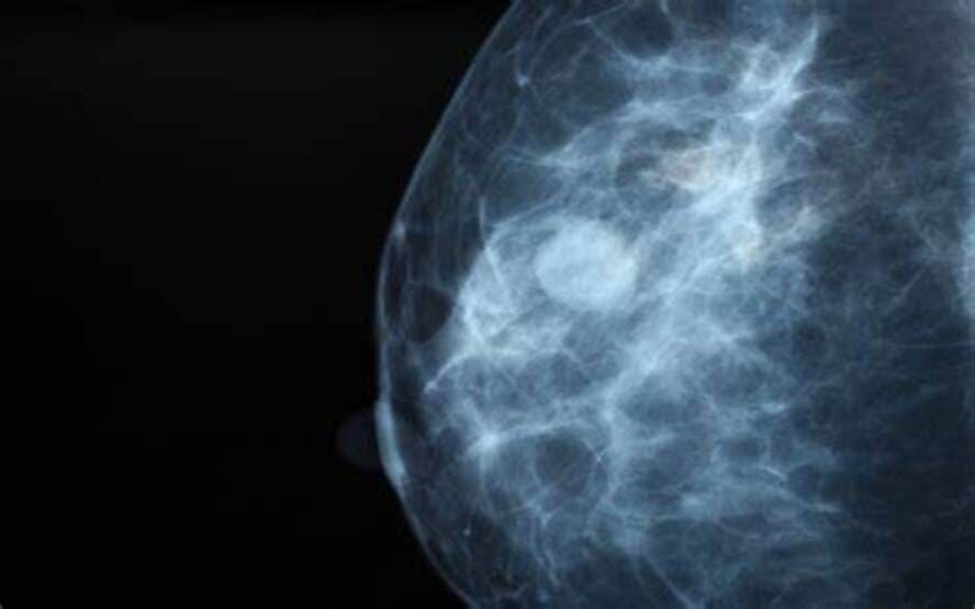 Cancer de mama e a relacao com o tamanho do tumor 2