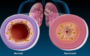 Tubos bronquicos e sua asma