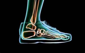 Como os sapatos impactam a artrite