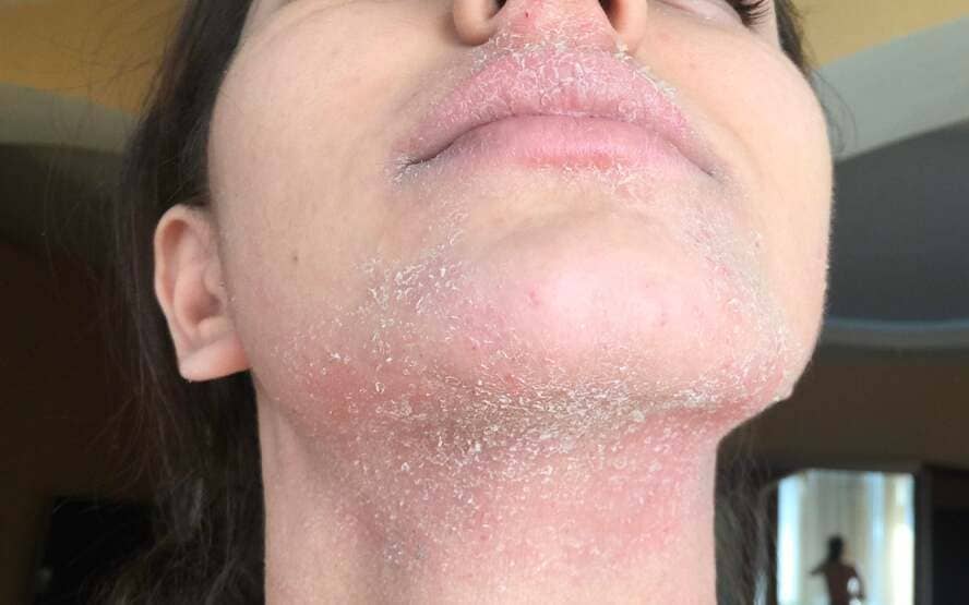 Eczema vs. Acne