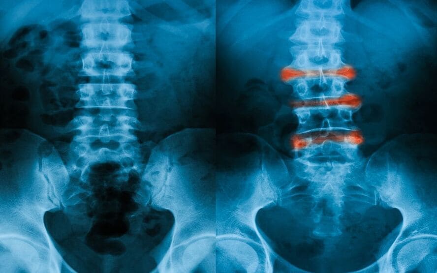 Espondilite Psoriatica 