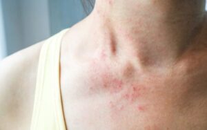 O que e acne escoriada e como tratar
