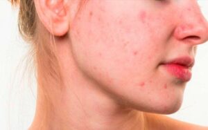 O que e acne vulgar