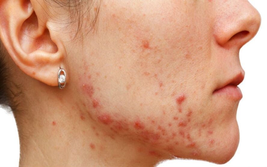 Quais sao os tipos e estagios da acne