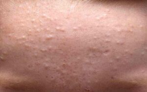 Tipos de manchas ou comedoes de acne