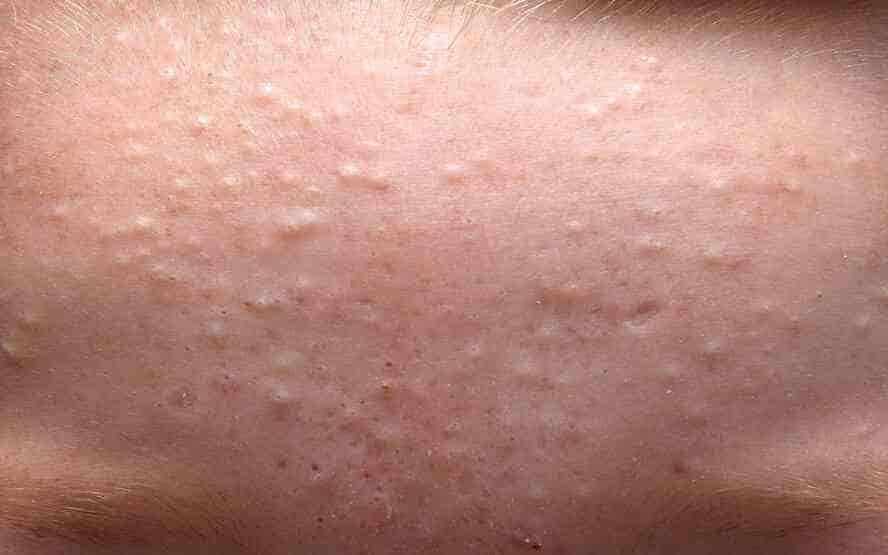 Waking Up With Bumps On Face