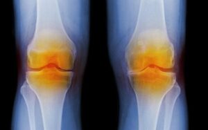 artrite da articulacao do joelho