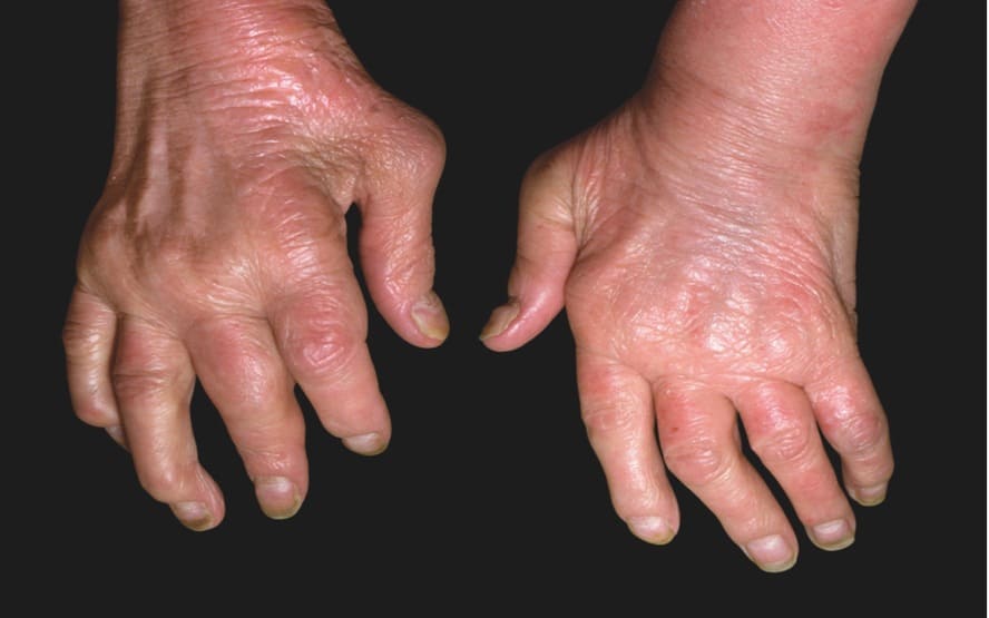 artrite psoriatica predominante interfalangiana distal