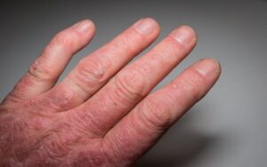 gatilhos da artrite psoriatica