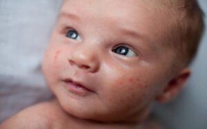 Como tratar a acne do bebe