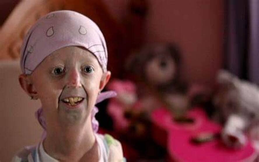 O que e Progeria