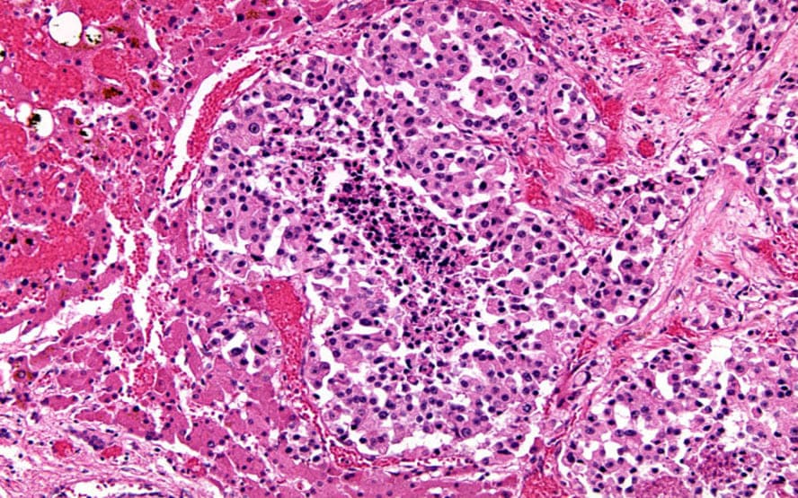 carcinoma hepatocelular