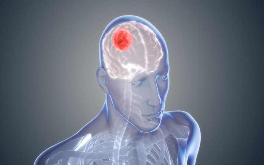 O que saber sobre cancer cerebral glioma