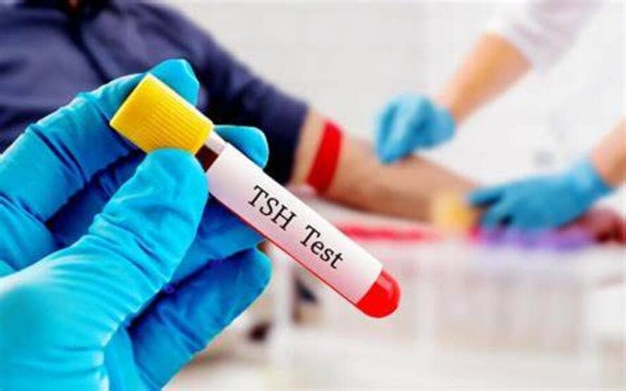 O que saber sobre o teste TSH