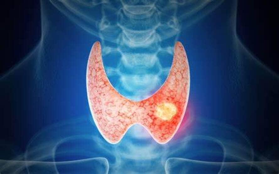 Sintomas do nodulo da tireoide