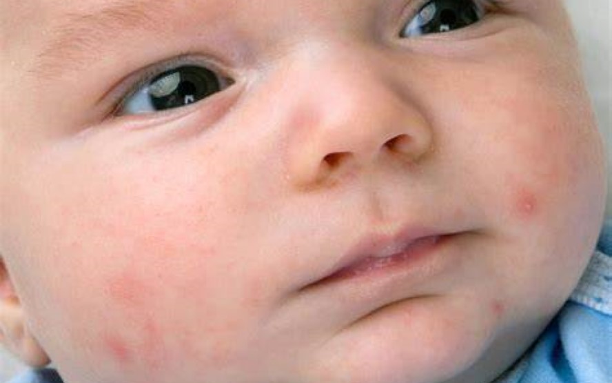 Acne em bebes criancas adolescentes e adultos 