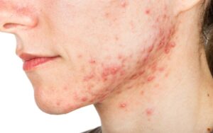 Causas da acne nodular e como trata la
