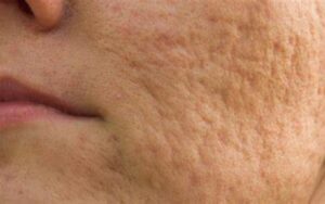 Causas de cicatrizes de acne e como evita las 
