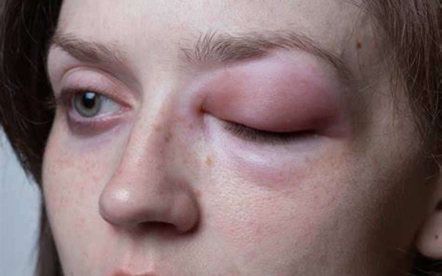 Causas do angioedema 