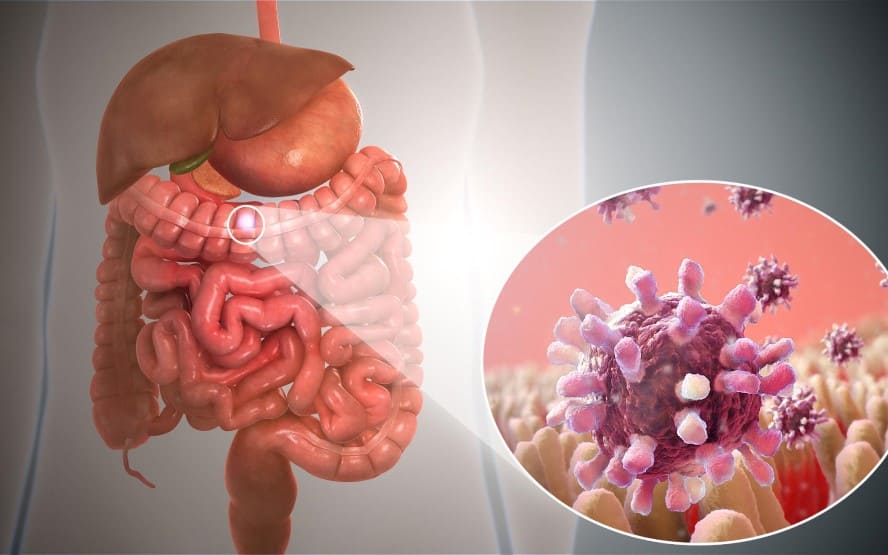 Gastrite vs. gastroenterite 