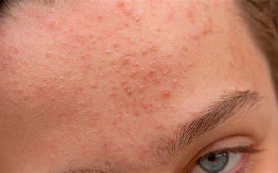 O que e acne comedonica