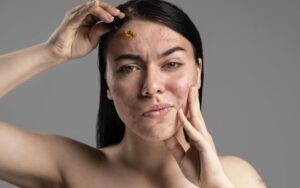 causas da acne pos parto