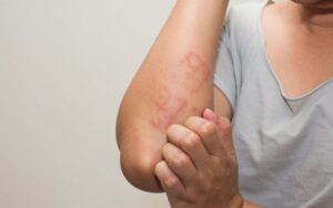 Dicas de autocuidado para dermatite atopica