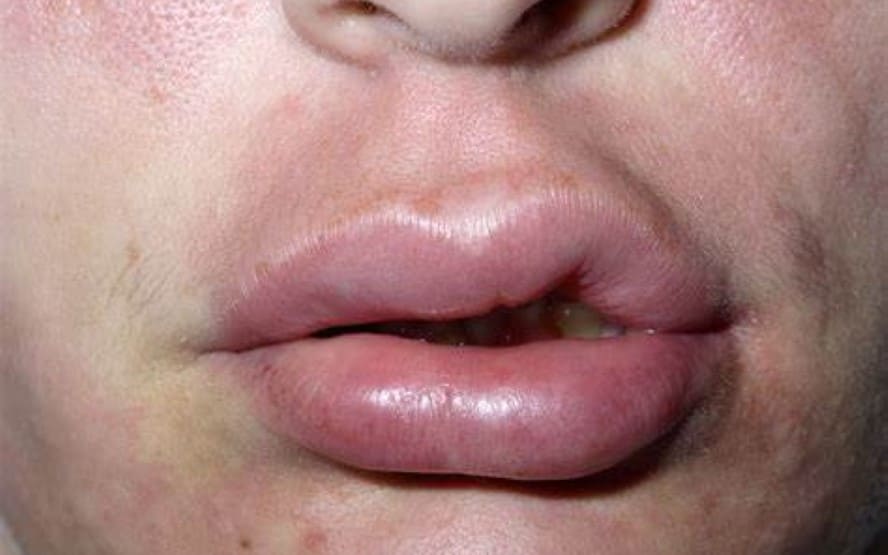 O que e Angioedema Hereditario