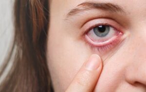 Olhos vermelhos podem ter sintomas graves
