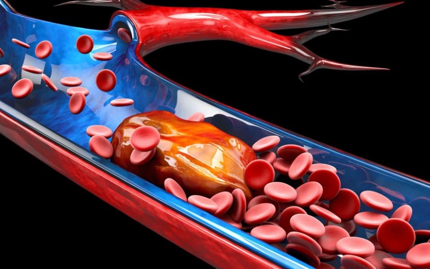 Como fazer a prevencao de coagulos sanguineos
