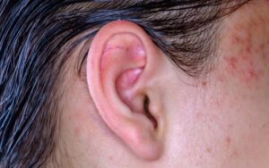Como remover uma espinha no ouvido 