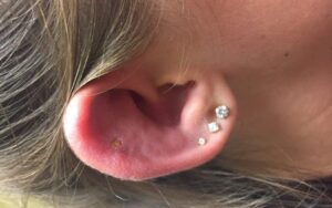 Como tratar um piercing de orelha infectado 