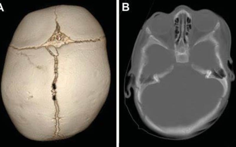 O que e Craniossinostose