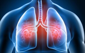 O que significa ter massa pulmonar