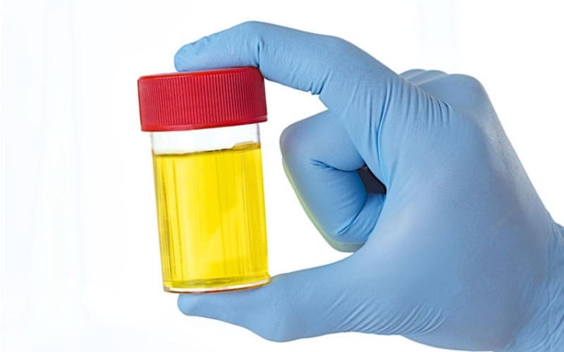 O que voce deve saber sobre leucocitos na urina