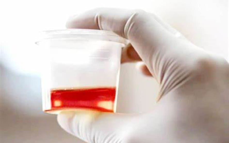 Possiveis causas de sangue na urina