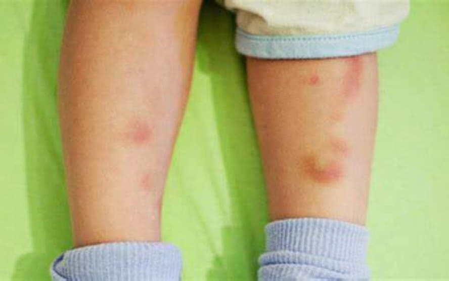 Sinais e sintomas de hematomas anormais em criancas